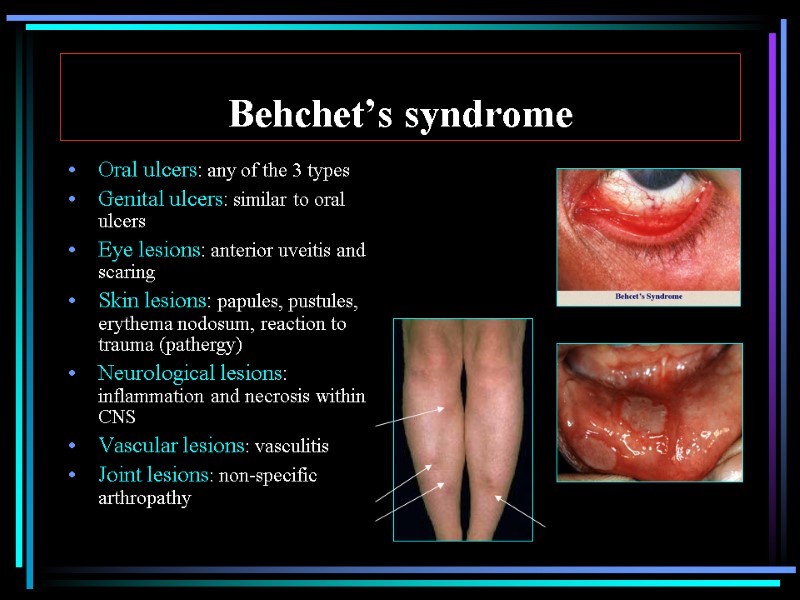 Behchet’s syndrome Oral ulcers: any of the 3 types Genital ulcers: similar to oral
